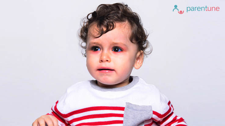 आंखों में इंफैक्शन Conjunctivitis के लिए घरेलू उपचार आंखों में इंफैक्शन Conjunctivitis के लिए घरेलू उपचार