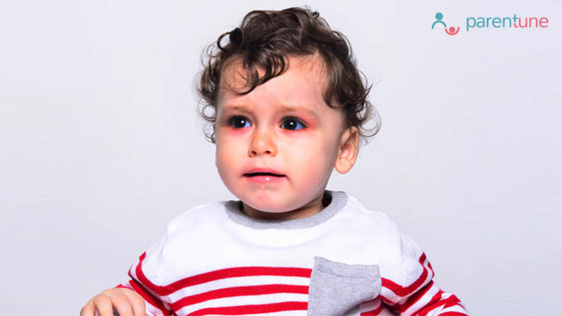 आंखों में इंफैक्शन (Conjunctivitis) के लिए घरेलू उपचार