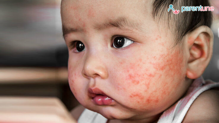 eczema in babies