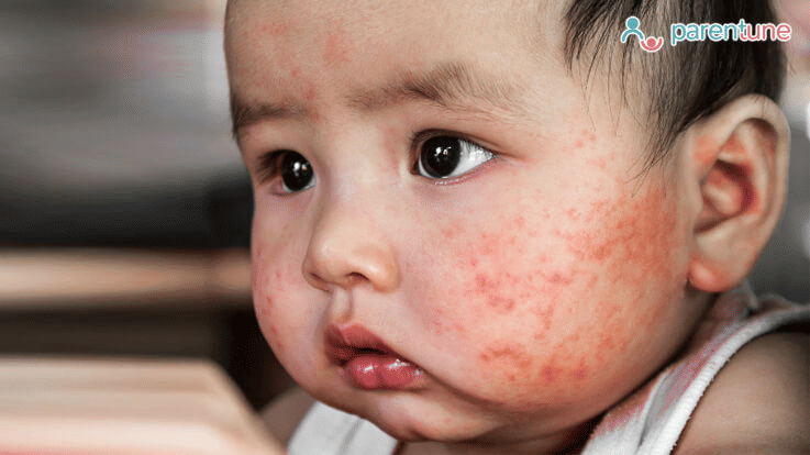 Parentune Eczema In Babies Symptoms Causes How To Diagnose Tips Home Remedies