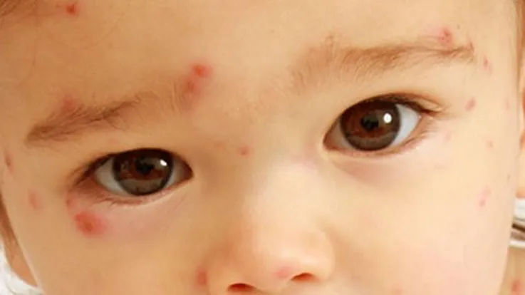 Tips to Protect Child from Chicken Pox, Risks Factors, Treatments