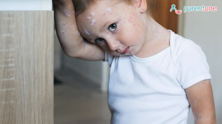 impetigo in children face