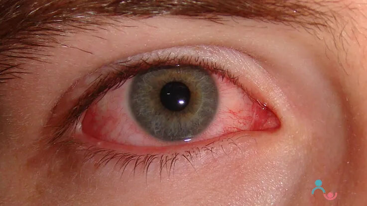 Important Myths and facts about Conjunctivitis Eye Flu Important Myths and facts about Conjunctivitis Eye Flu