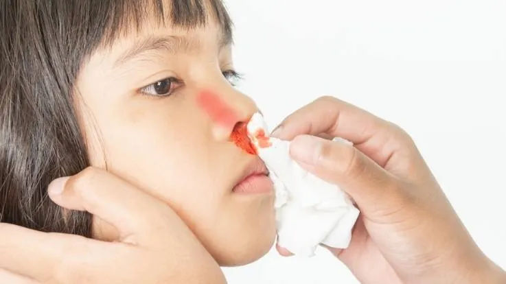 Why Nose Bleeding In Children Reasons Prevention Tips Precautions 