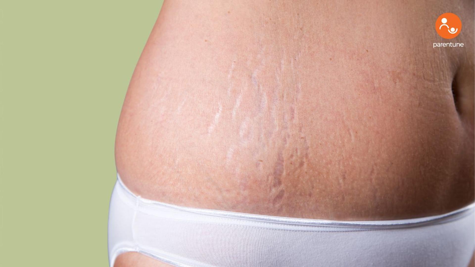 Stretch Marks In Pregnancy: Myths, Prevention, And Truths