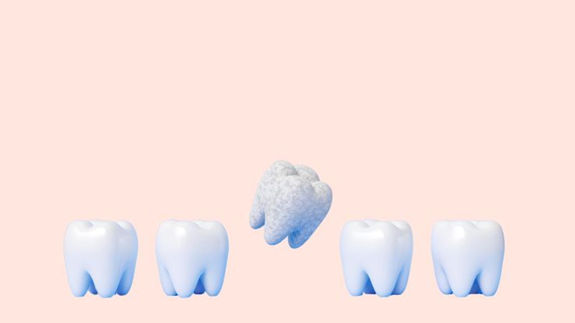 Tooth Decay Signs, Causes & Prevention Remedies in Children