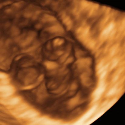 9-weeks-and-5-days-pregnant-baby-fetal-progress-ultrasound