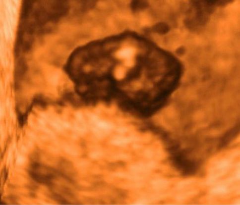 7-weeks-and-5-days-pregnant-baby-fetal-progress-ultrasound