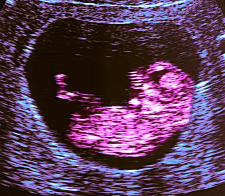 10 weeks and 3 days pregnant Baby Fetal Progress, Ultrasound