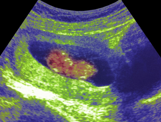 11-weeks-and-4-days-pregnant-baby-fetal-progress-ultrasound