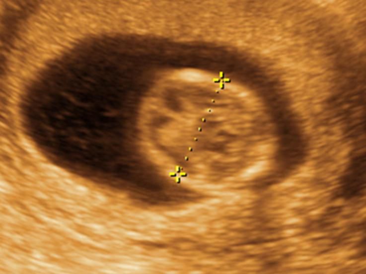 13 Weeks And 2 Days Pregnant Baby Fetal Progress Ultrasound 