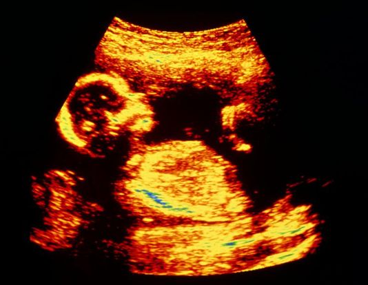 18-weeks-and-4-days-pregnant-baby-fetal-progress-ultrasound