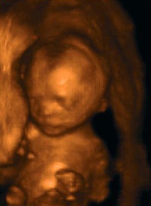 20 weeks ultrasound