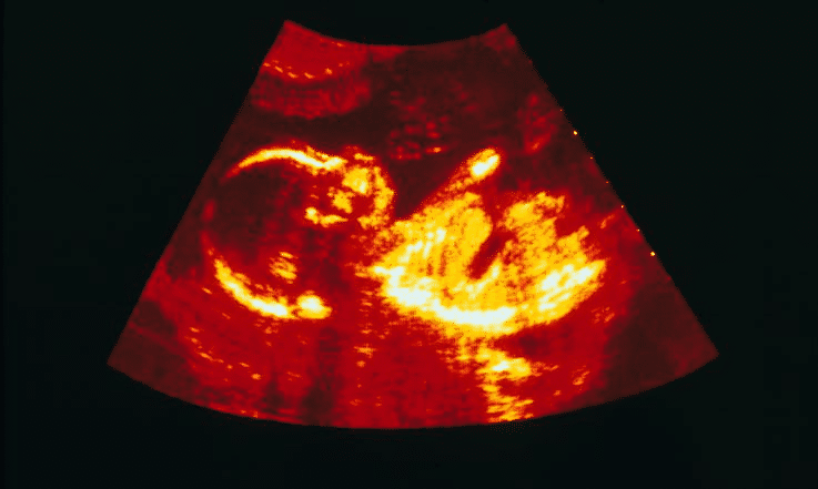 23 weeks and 2 days pregnant - Baby Fetal Progress, Ultrasound