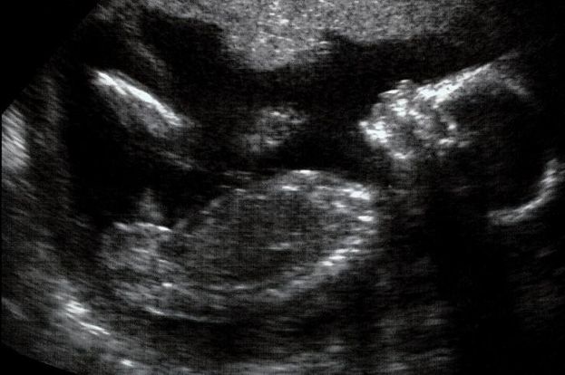 23 weeks ultrasound