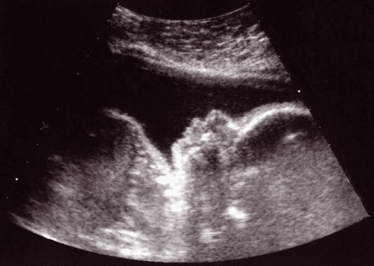 25 weeks and 1 day pregnant Baby Fetal Progress