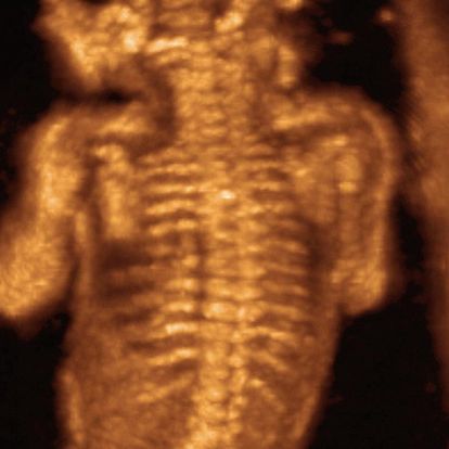 25 weeks fetus ultrasound