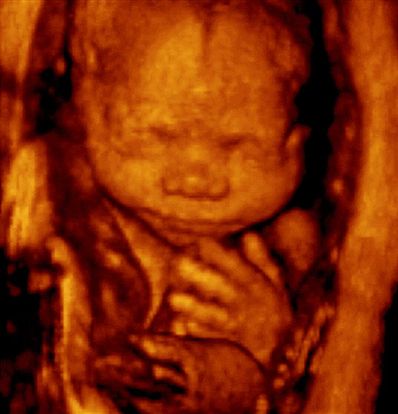 25 weeks fetus ultrasound