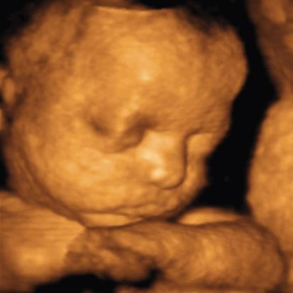 32 weeks ultrasound