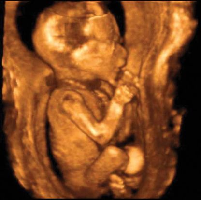 Parentune 18 Weeks And 4 Days Pregnant Baby Fetal Progress Ultrasound Nutrition Tips And Advice